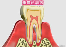 重度歯周病