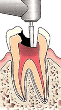 歯の神経を明示