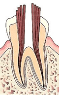 固定式の薬剤を入れてレントゲン写真で確認後、根の治療が全部終了